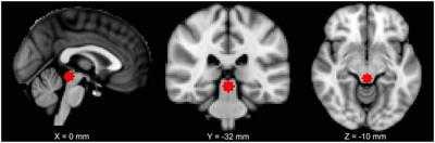 Lower Functional Connectivity of the Periaqueductal Gray Is Related to Negative Affect and Clinical Manifestations of Fibromyalgia